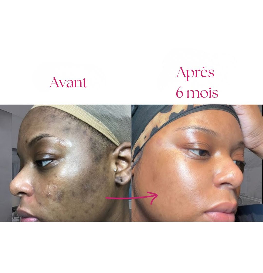 Tampons exfoliants (Curcuma et acide kojic)