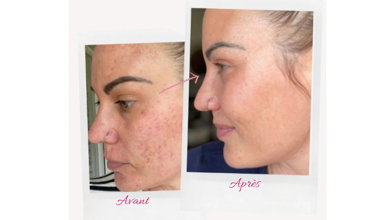 Tampons exfoliants (Curcuma et acide kojic)